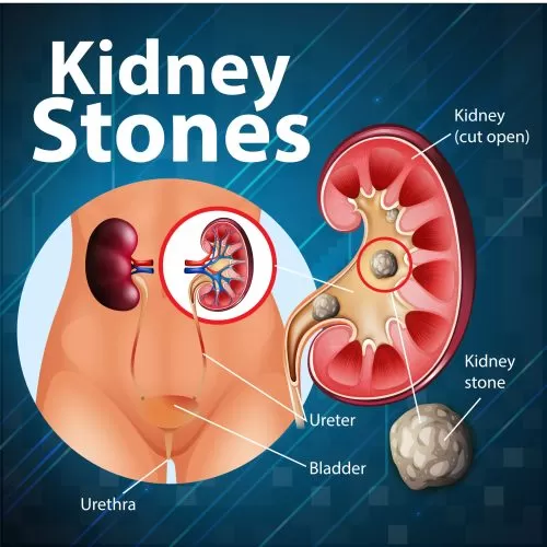 Informative illustration of kidney stones illustration